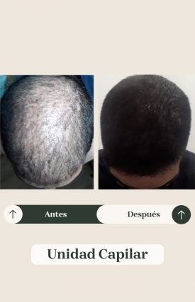 Unida Capilar2222 Rpivkx0k7tbmnpt9pq1v1akepe7ifjxttmrnyz5yz4